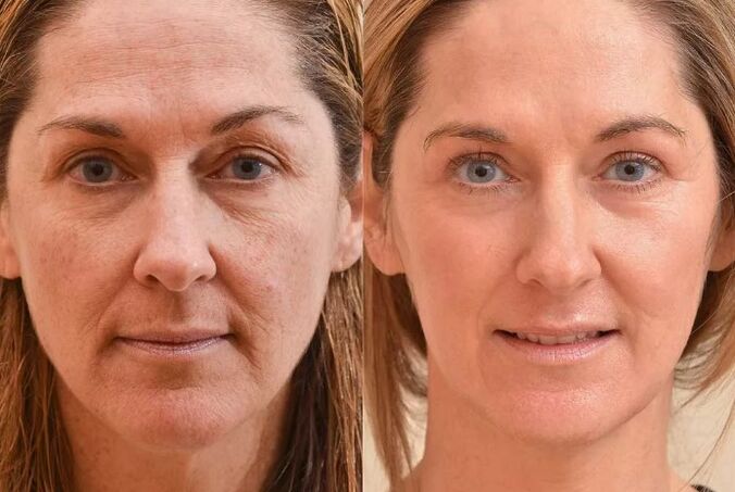 Before and after the face renewed