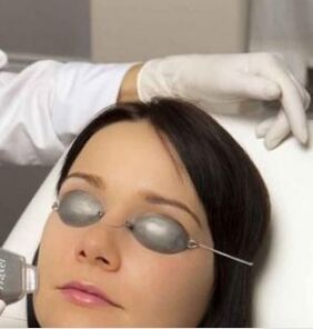Field laser rejuvenation