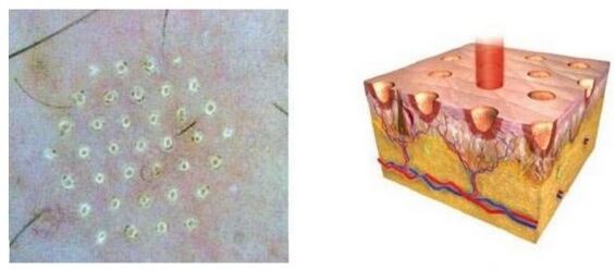 The fractionated laser affects the skin point