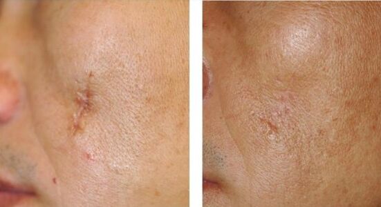 The result of the laser