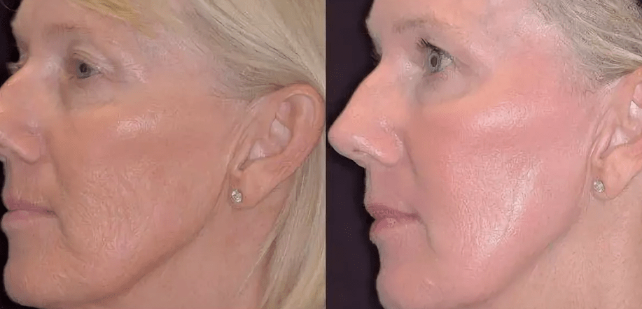Before and after laser photothermolysis