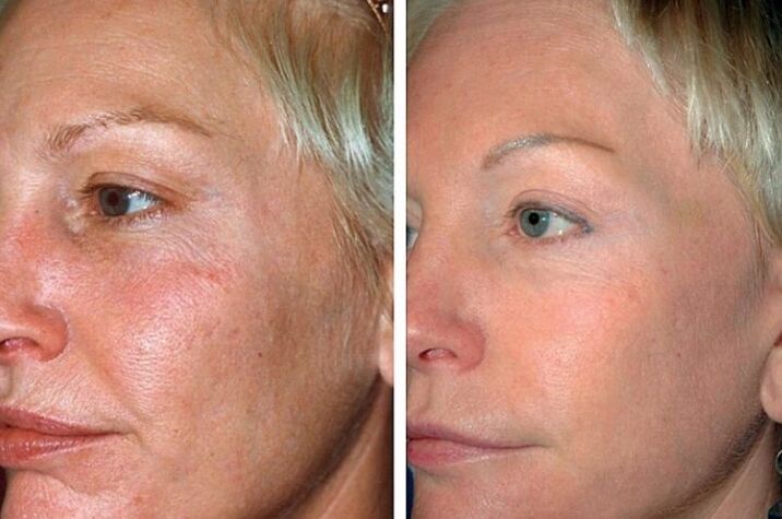 Before and after the rejuvenation procedure