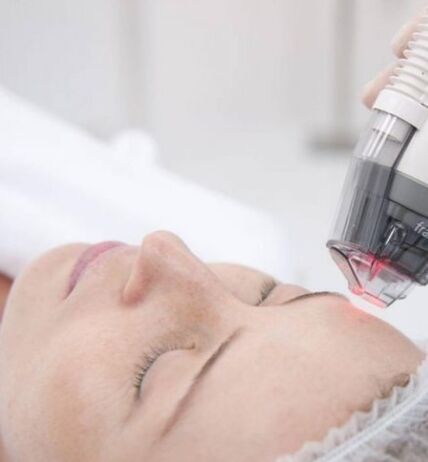 Photothermolysis
