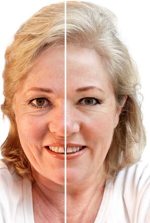 The renewal of the face