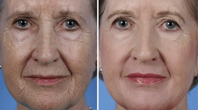 fractional face skin rejuvenation before and after photos