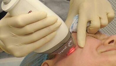 How fractional skin rejuvenation is done