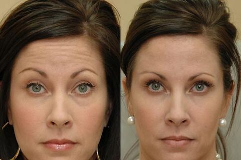 Botulinum toxin injections can be used in any area of ​​the face