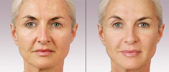 Contour plastic
