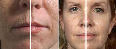 before and after fractional skin rejuvenation