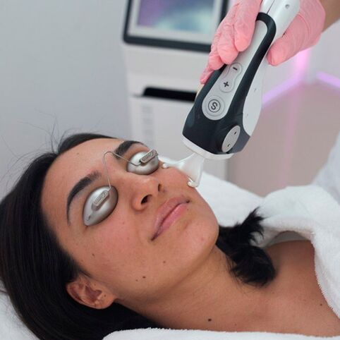 Facial skin treatment with fractionated laser