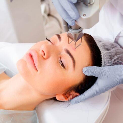 Photothermolysis procedure for facial skin renewal
