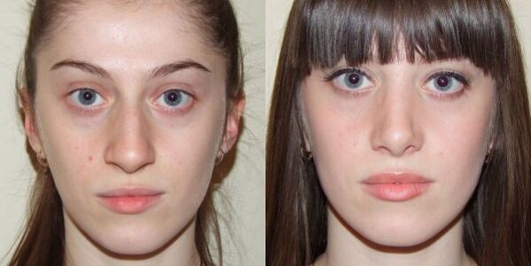 Girl plasma facial skin rejuvenation before and after