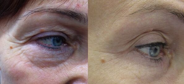 It is the result of effective plasma rejuvenation of the eye area